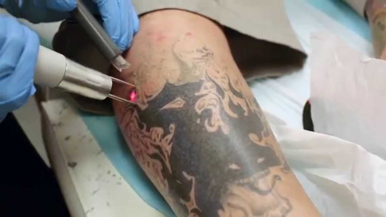 Tattoo Removal | Laser Express Beauty
