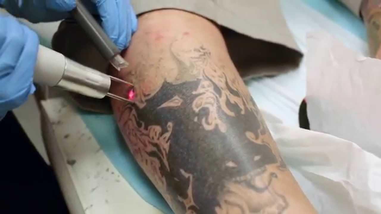 Tattoo Removal Laser Express Beauty